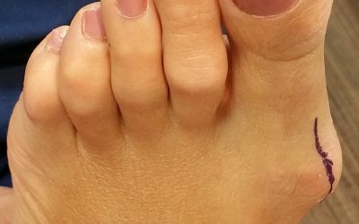 Surgical Correction of Bunions