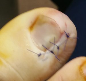 ingorwn toenails