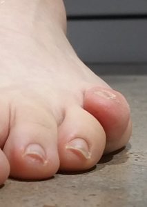 toe correction