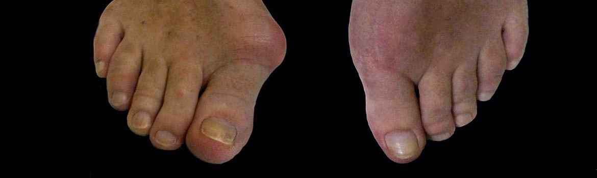 bunion-surgery-featured