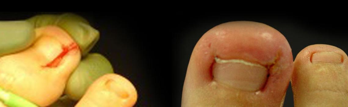 ingrown-toenail-featured